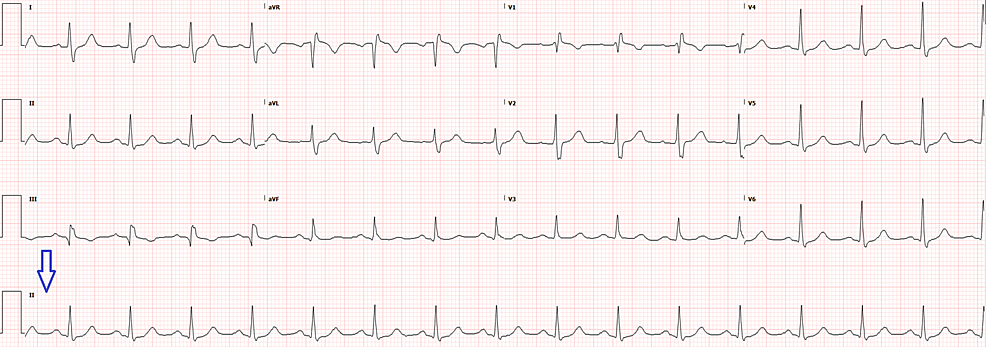 Ekg Strip Search Supraventricular Tachycardia Svt Ekg Svt Heart Images