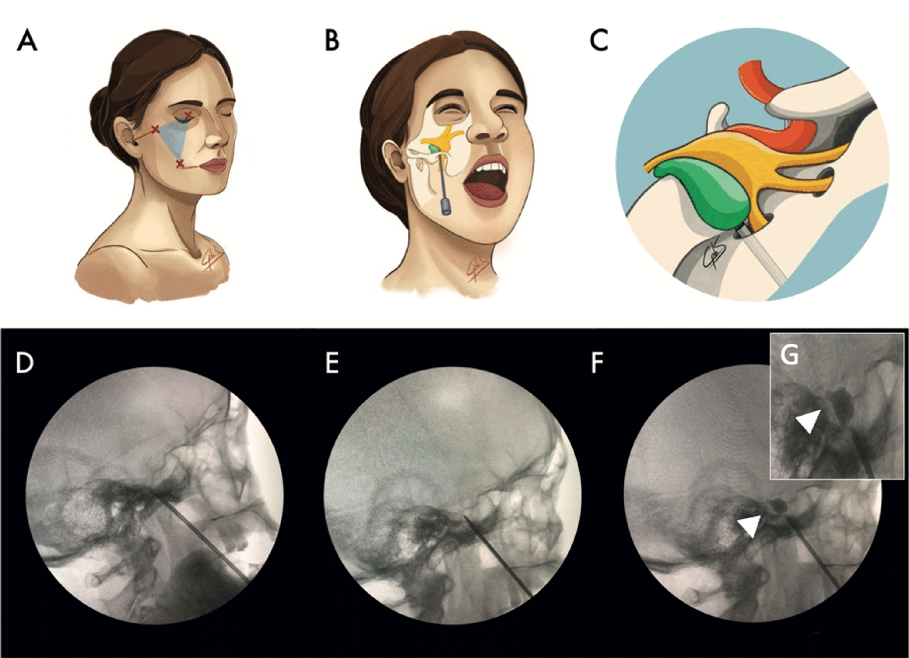 Percutaneous Balloon Compression For The Treatment Of Trigeminal