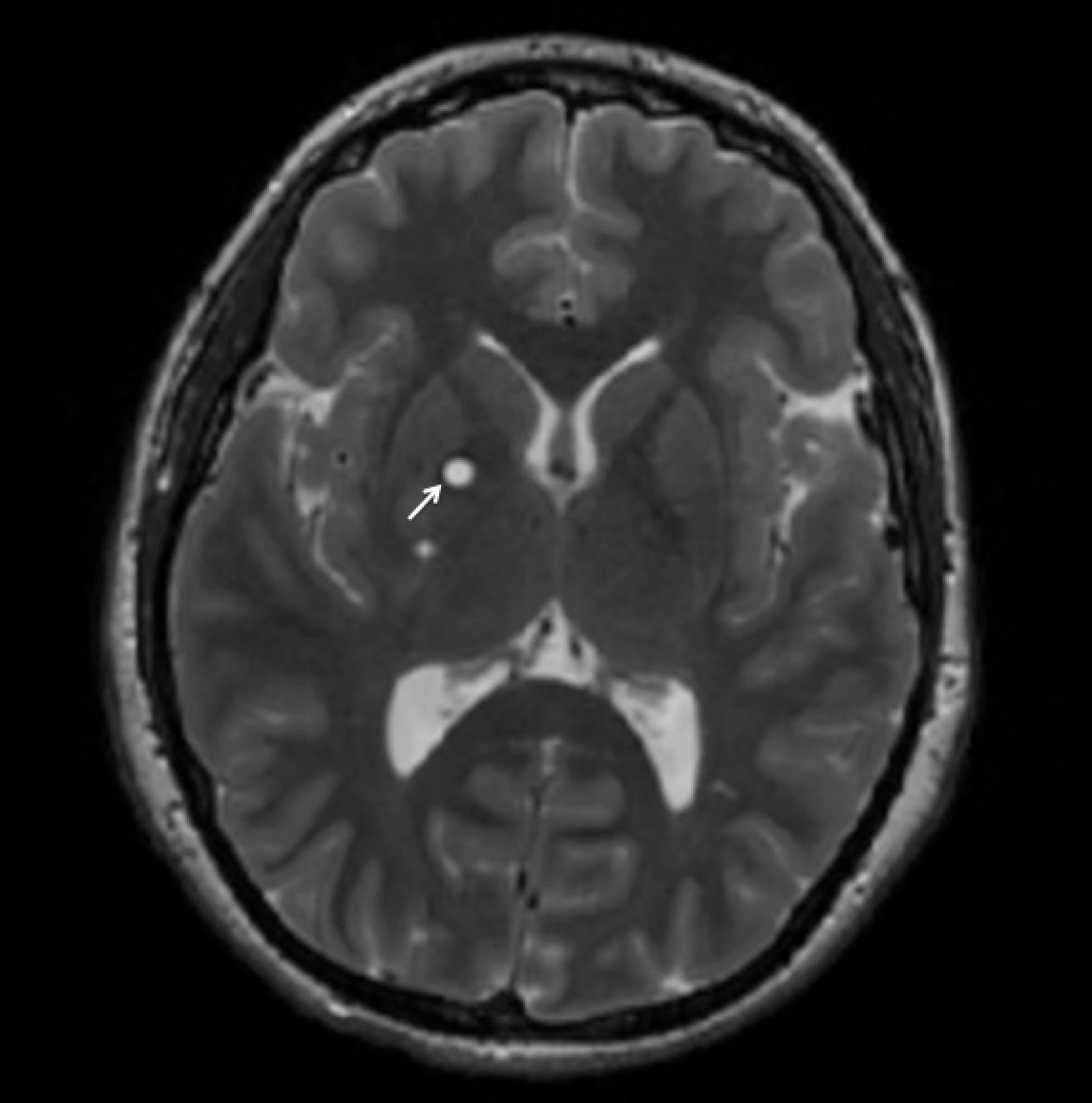 Ogniska Hiperintensywne W Obrazach T2 I Flair O Charakterze Naczyniopochodnym Cureus | Hypoplastic Internal Carotid Artery Co-Presenting with