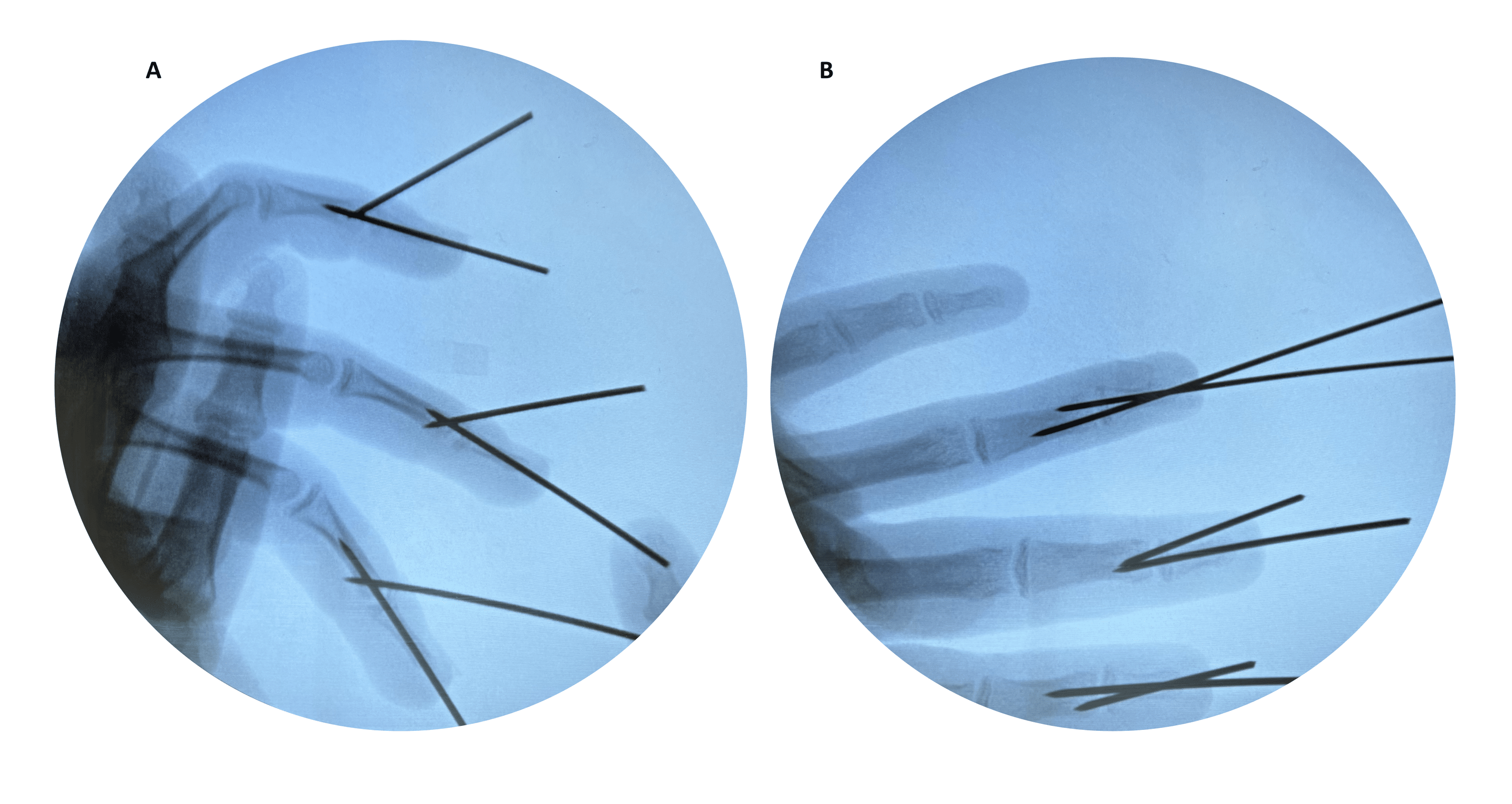 Multiple Bony Mallet Finger Injuries In One Hand Of A 14 Year Old Boy