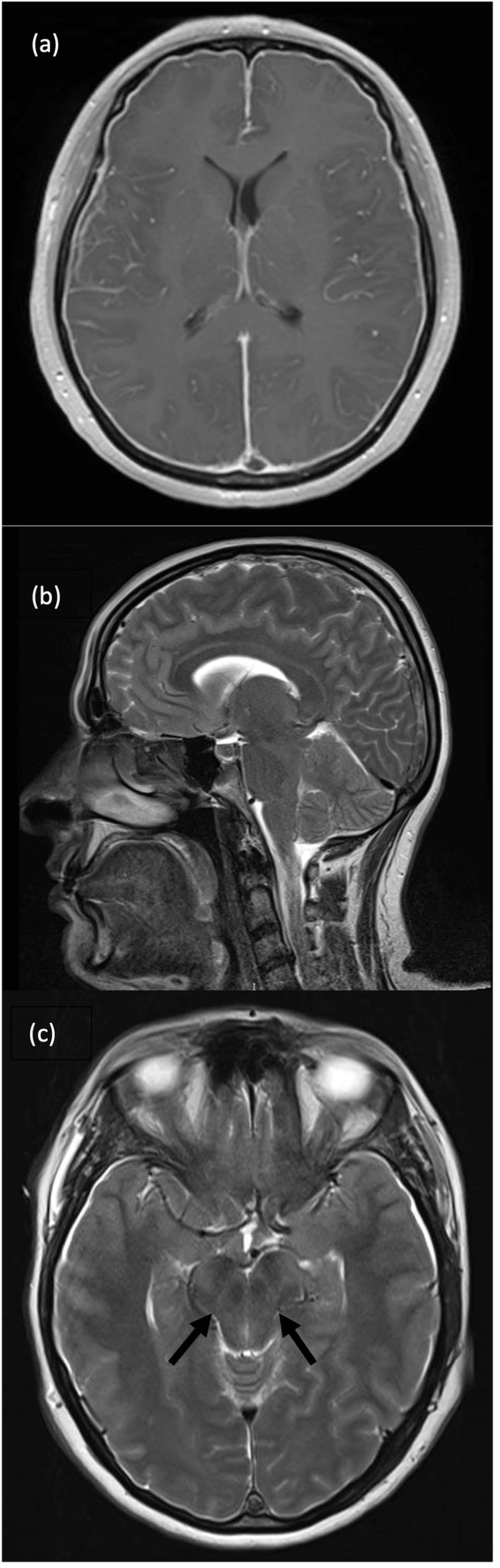 Superior Sagittal Sinus Thrombosis In A Patient With Iatrogenic