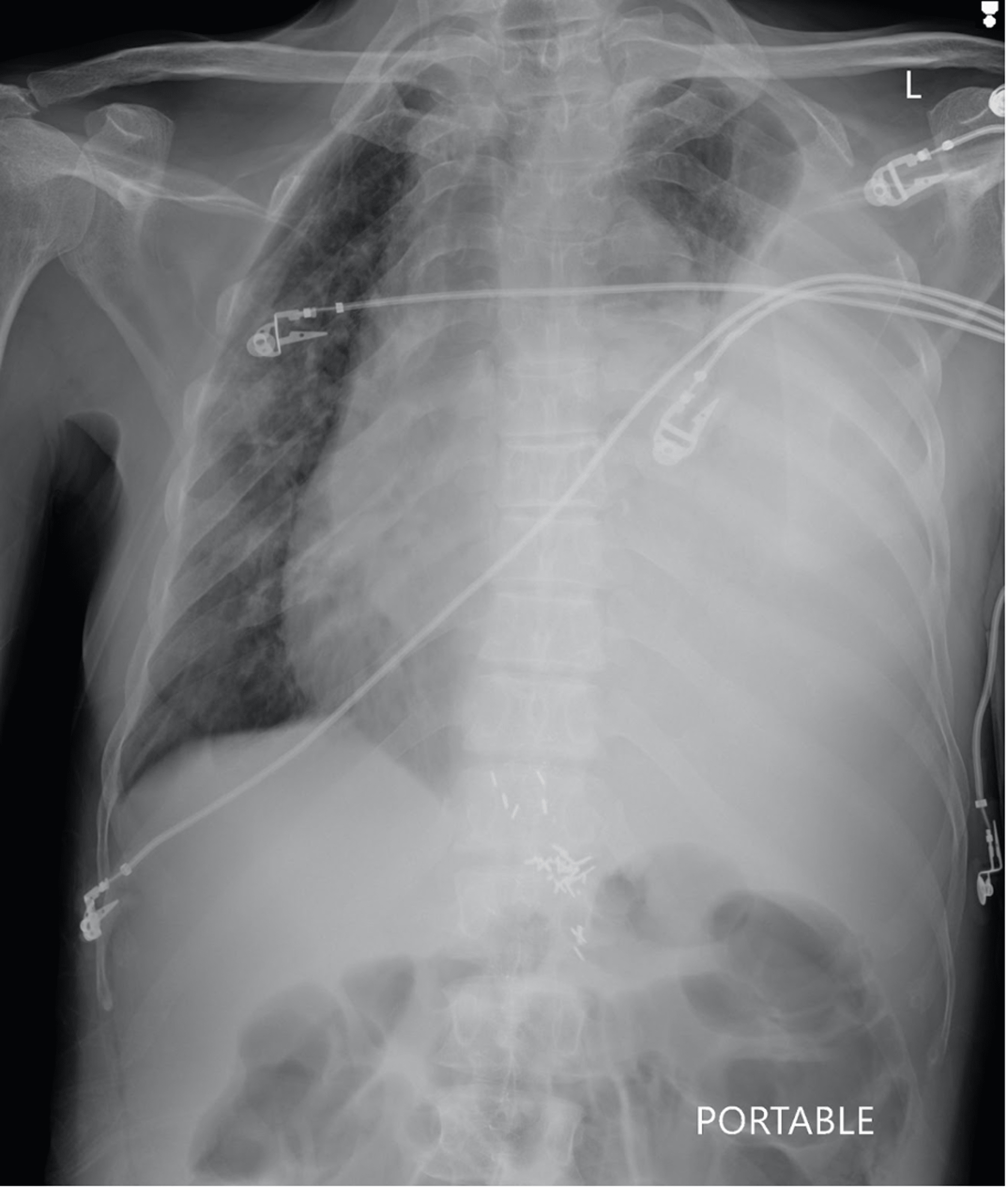 Cureus Massive Myelomatous Pleural Effusion With Contralateral