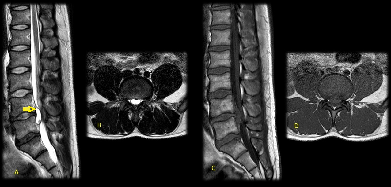 Cureus Traumatic Lumbar Interdural Cyst With Intradural Expansion And