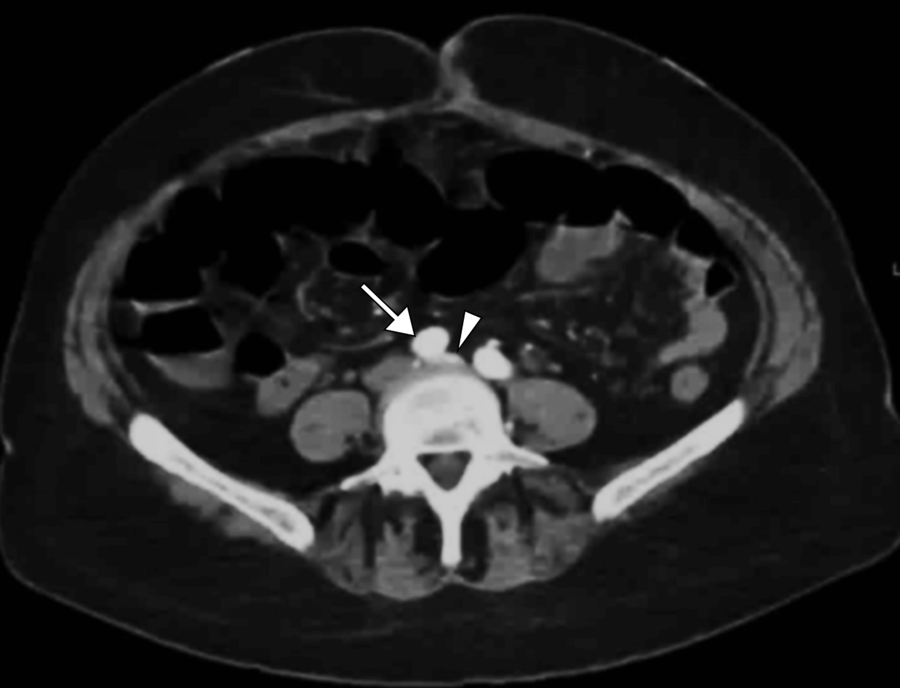 Endovascular Stenting For May Thurner Syndrome A Case Report Cureus