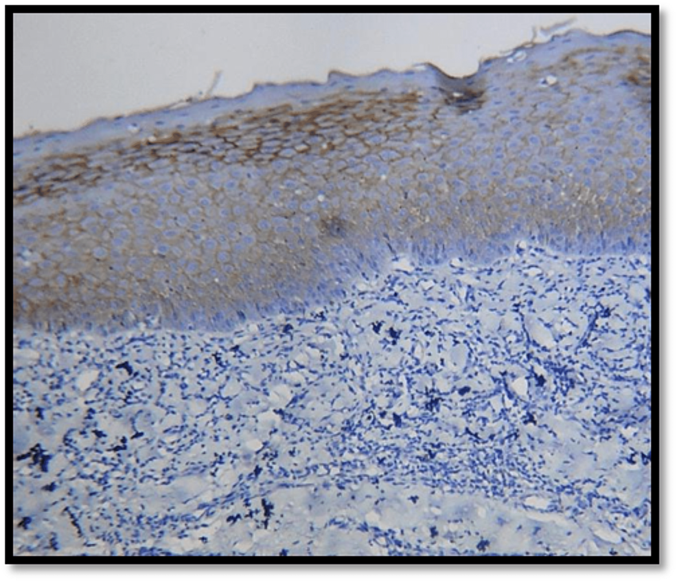 E Cadherin Expression In Premalignant Lesions Premalignant Conditions