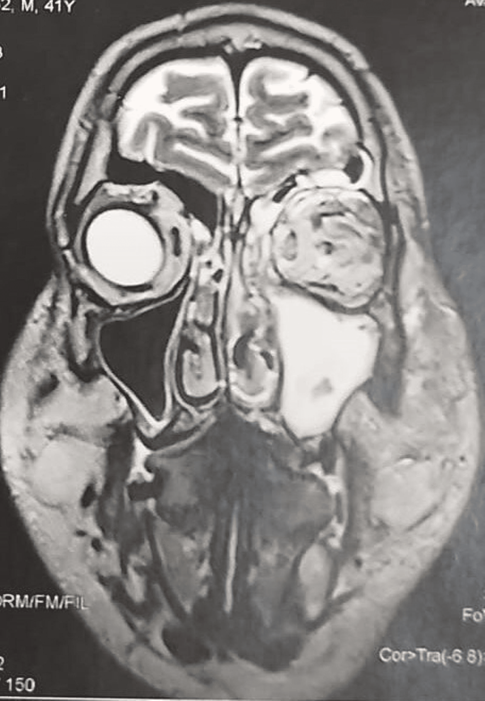 Rhino Orbito Cerebral Mucormycosis A Challenging Case Cureus