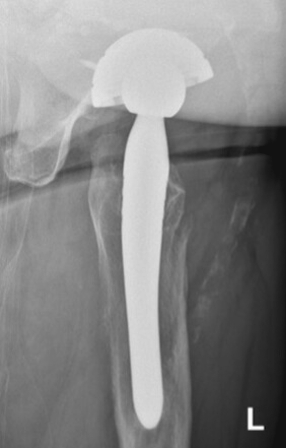 Cureus Postoperative Load Bearing In Periprosthetic Femoral Fractures