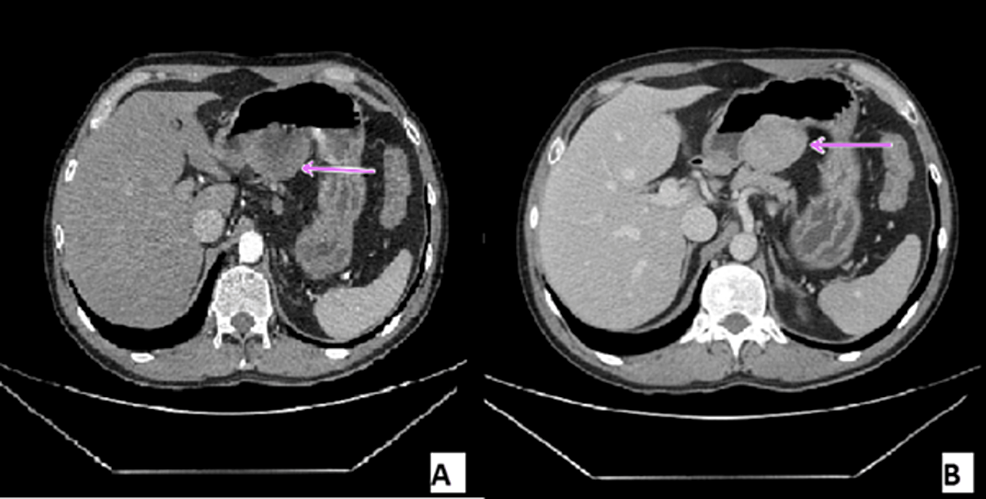 Gastric Schwannoma A Rare Subepithelial Lesion Of The Stomach Cureus