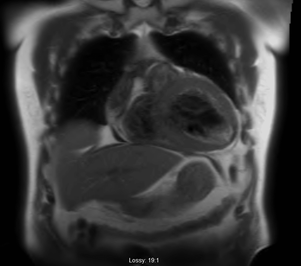 Failure To Confirm Typical Echocardiographic Findings Of Cardiac