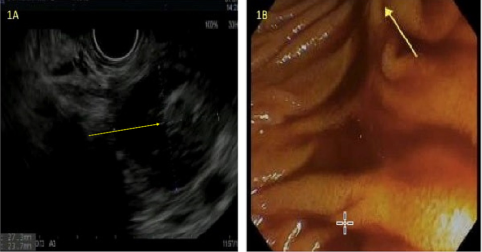 Cureus Endoscopic Ultrasound Assisted Diagnosis Of Obscure