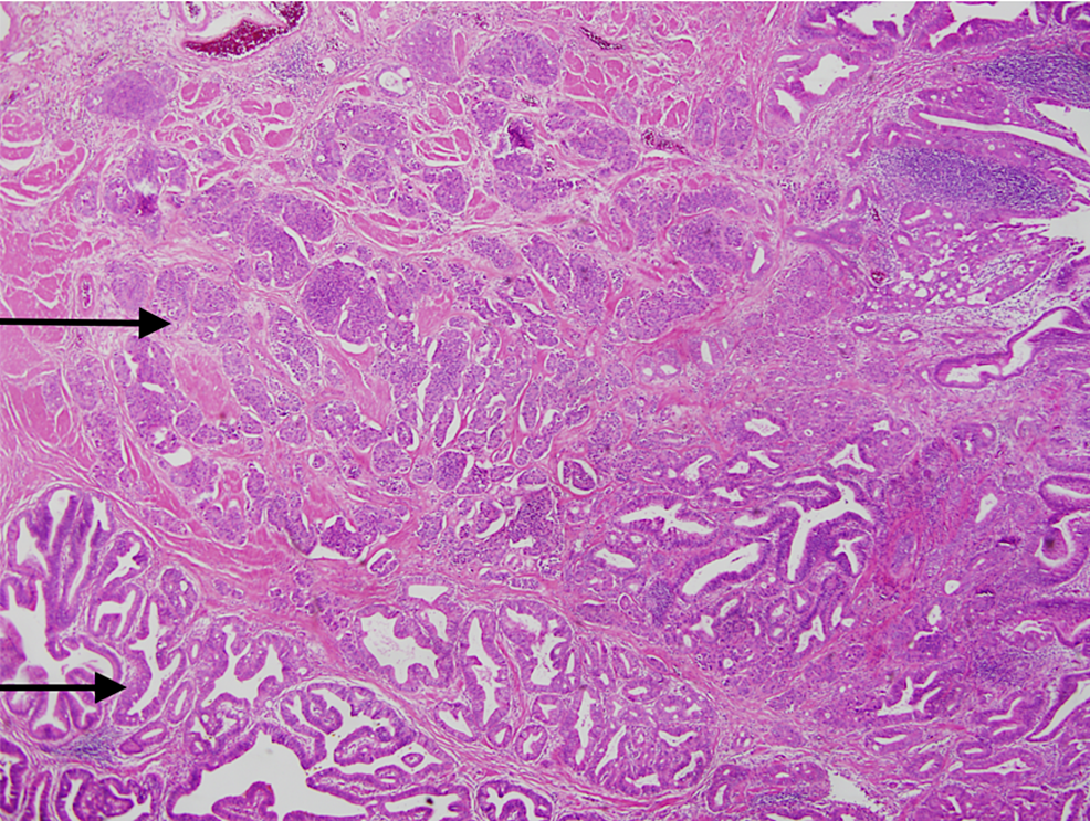 Cureus When Adenocarcinoma Went Hand In Hand With Neuroendocrine Tumor A Rare Case Of