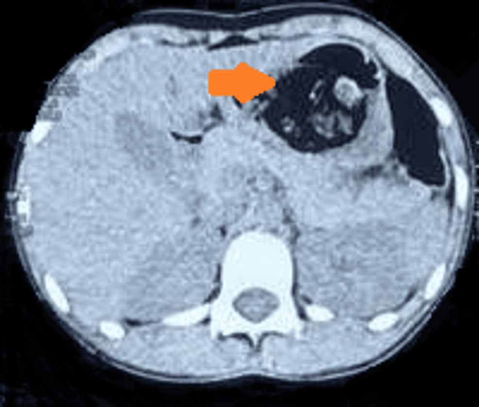 Cureus Rapunzel Syndrome A Rare Case Of Phyto Trichobezoar In An