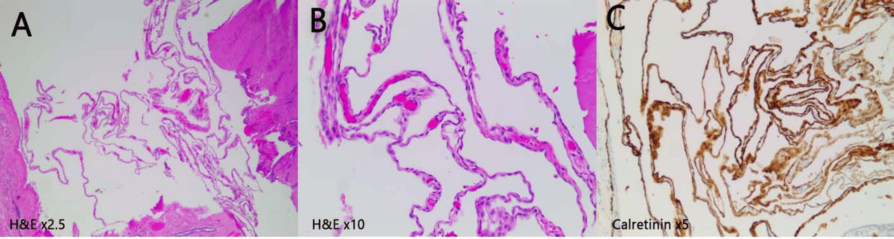 Hepatic Benign Cystic Mesothelioma In Adults A Case Report Of A Rare