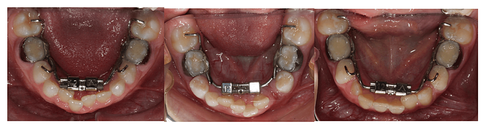 Skeletal And Dentoalveolar Changes With Mandibular Expansion In Growing