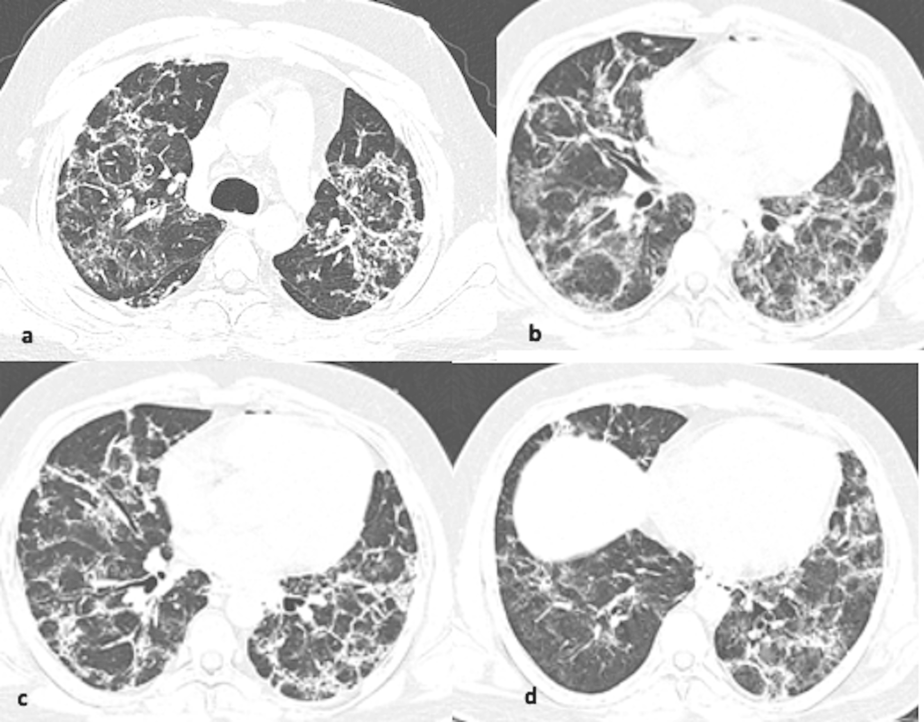 Cureus Radiological Patterns Of Lung Injury On HRCT In COVID 19