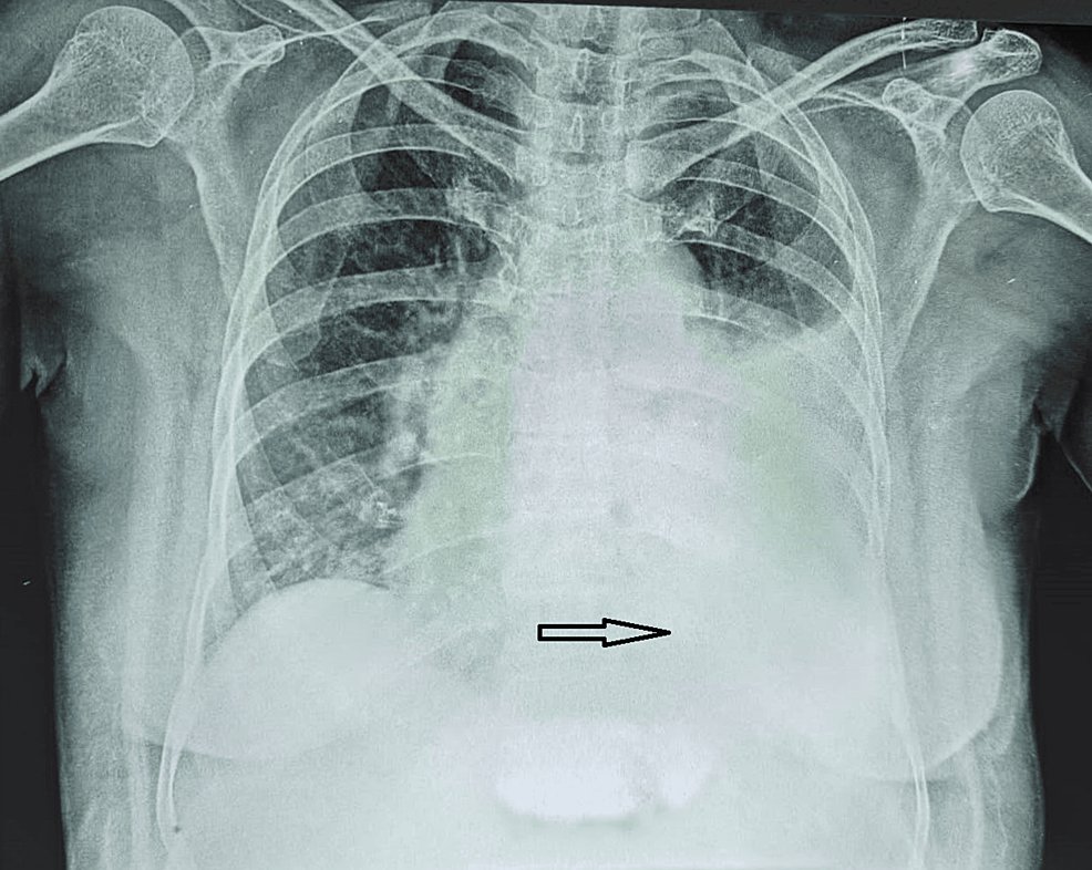 Multiple Myeloma A Rare Presentation As Unilateral Pleural Effusion