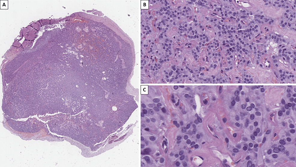 Cauda Equina Neuroendocrine Tumor A Histopathological Case Report Cureus