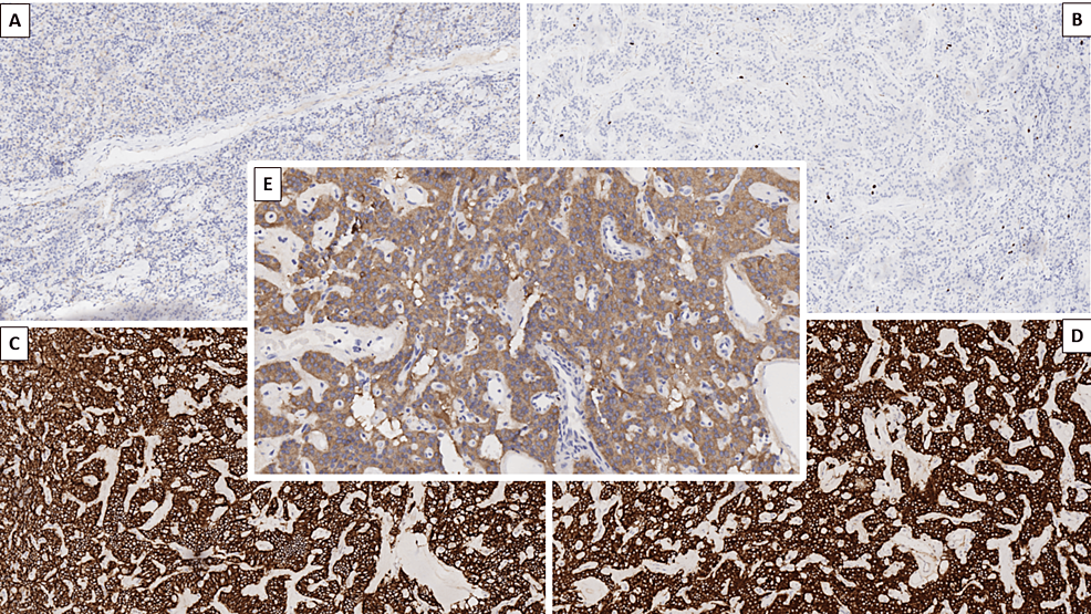 Cauda Equina Neuroendocrine Tumor A Histopathological Case Report Cureus