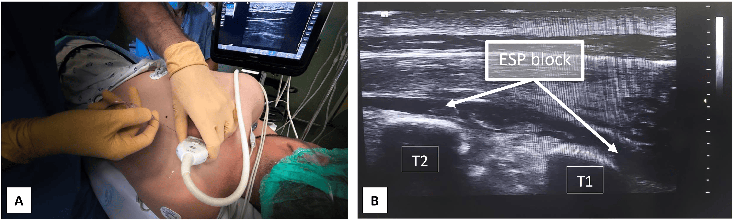 Cureus Effective Postoperative Pain Management In Thoracic Outlet