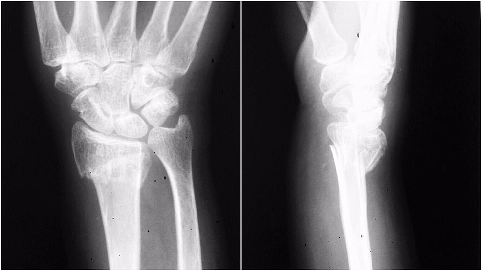 Cureus A Rare Combination Of Complex Elbow Dislocation And Distal Radial Fracture In Adults 