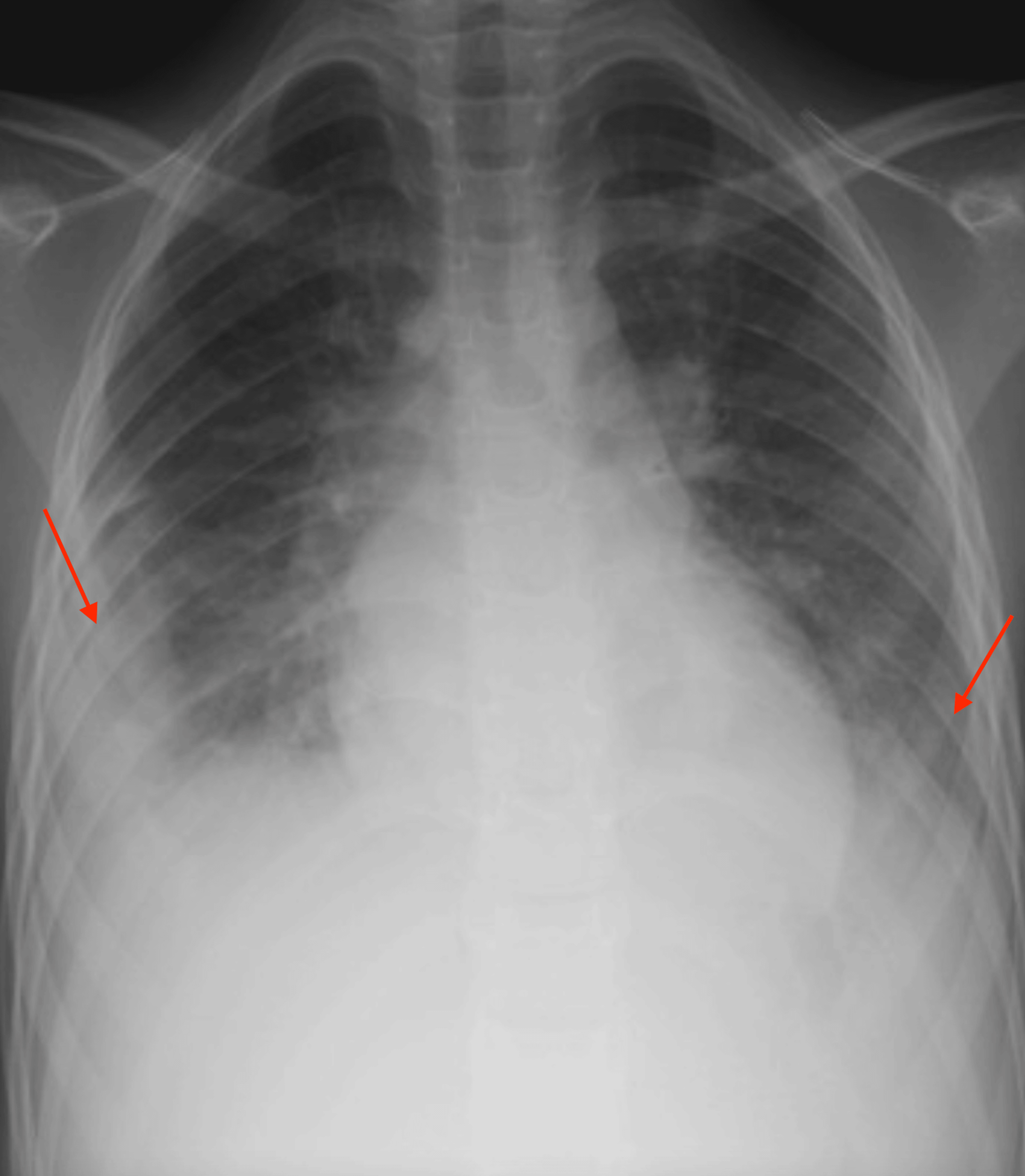 A Challenging Diagnosis Of Kawasaki Disease Shock Syndrome Complicated