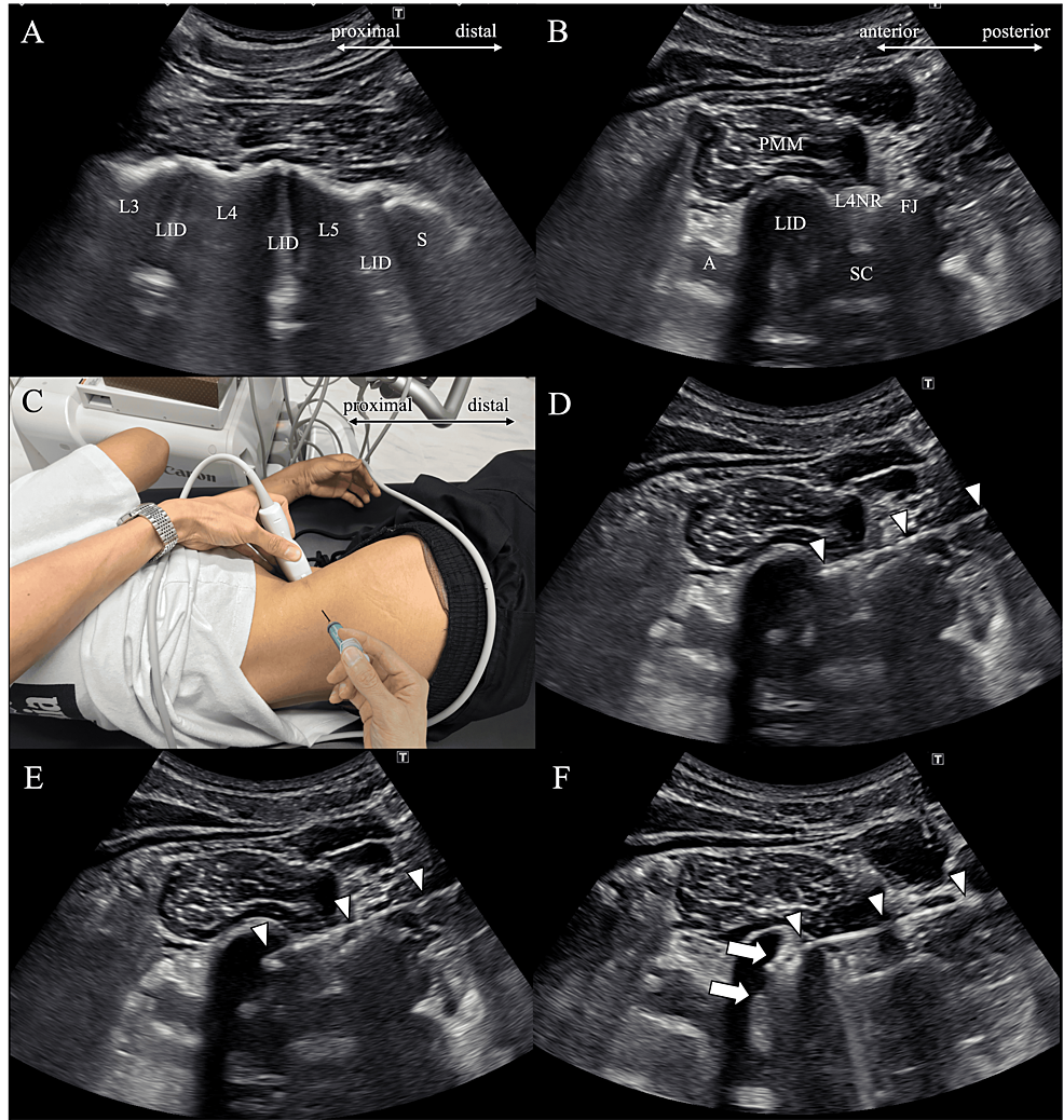 Ultrasound Guided Lumbar Intradiscal Injection A Case Report With A