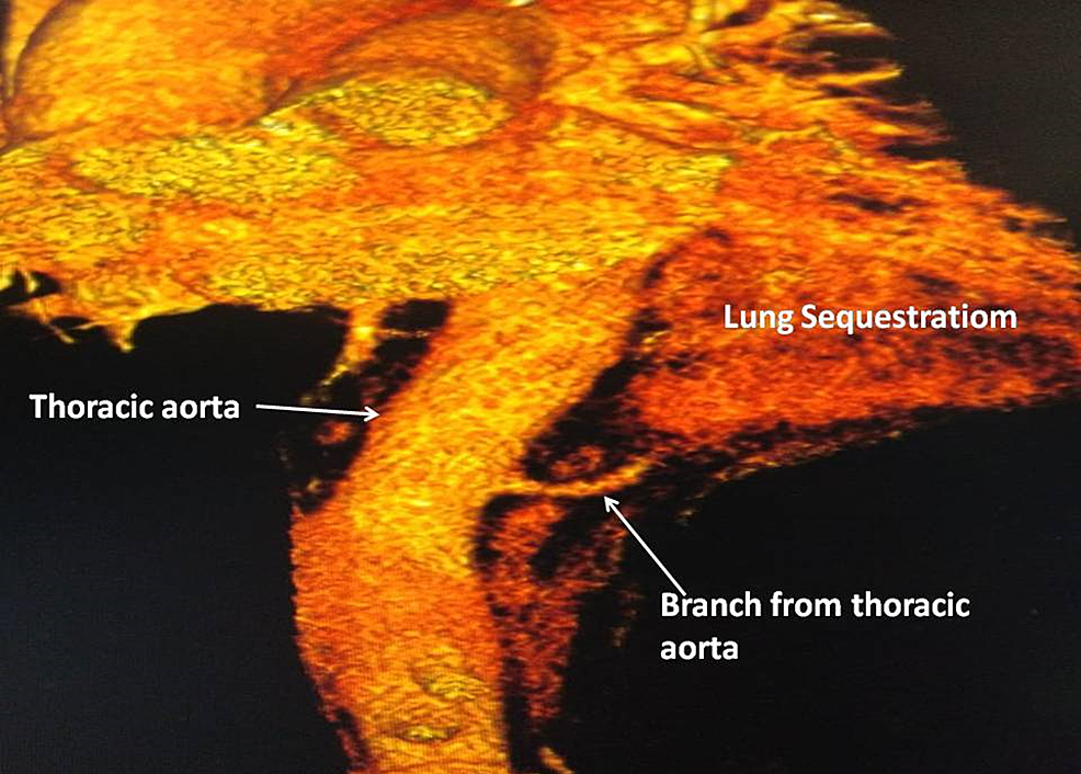 feeding-artery-from-the-posterolateral-thoracic-aorta-supplying