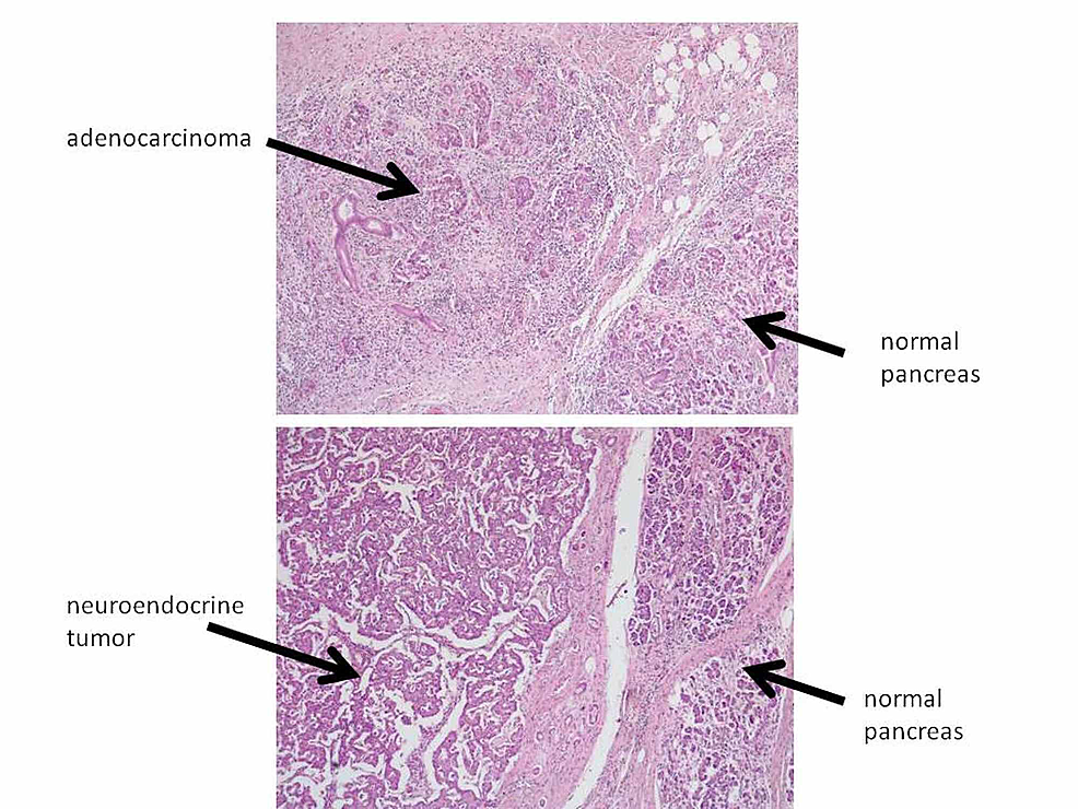 Cureus Ampullary Adenocarcinoma With Incidental Pancreatic Neuroendocrine Tumor Report Of An