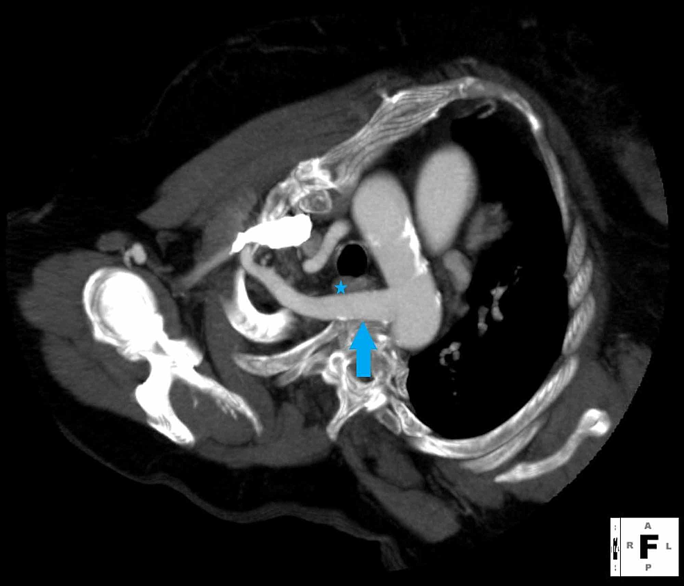 Aberrant Right Subclavian Artery With A Bicarotid Trunk The Importance