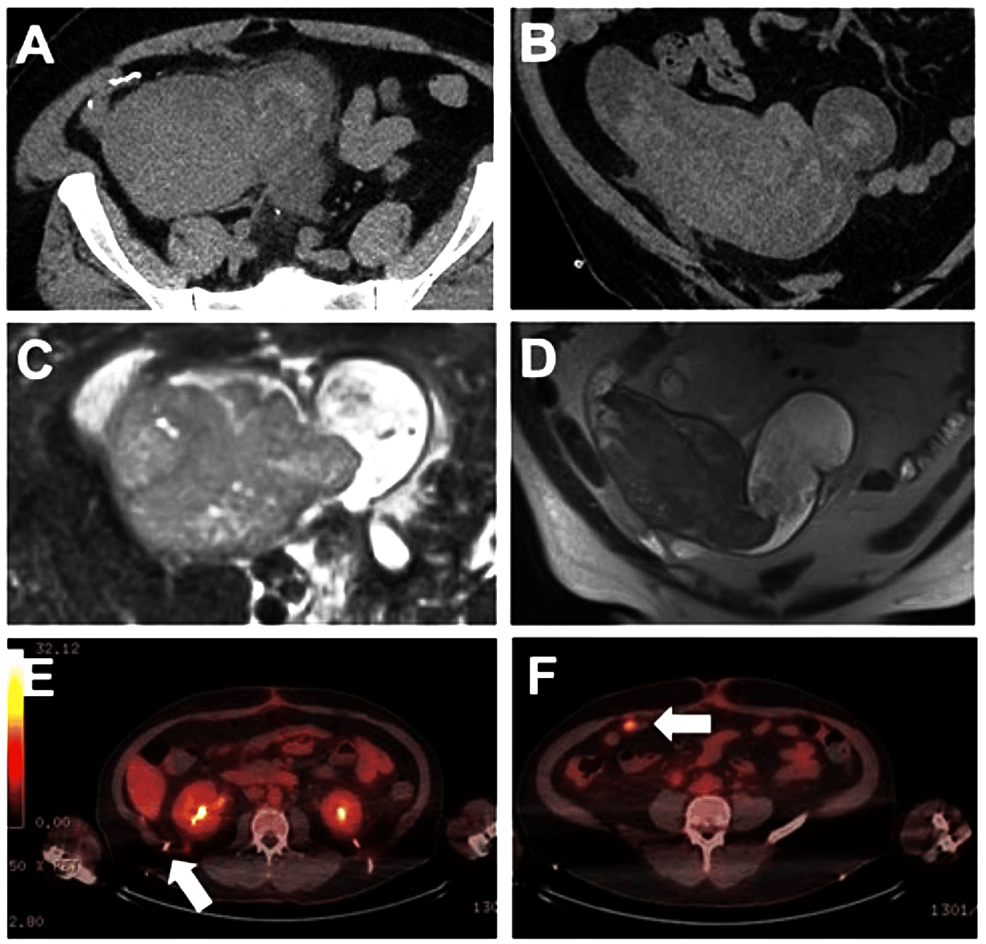 Urothelial Carcinoma Recurrence With An Ileal Conduit Multimodal