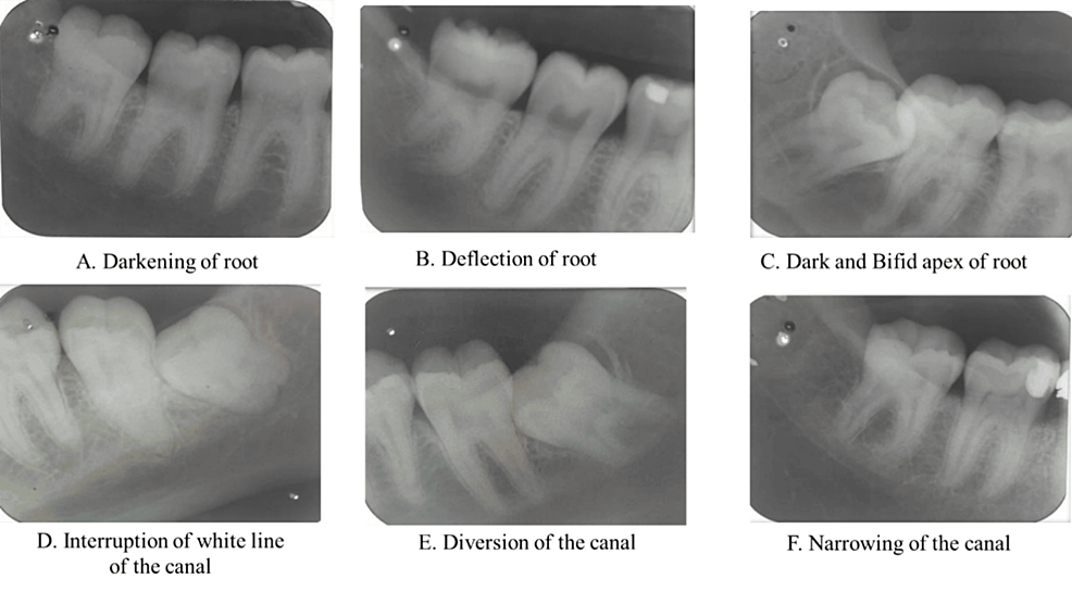 Association Of Radiographic Signs In Determining The Proximity Of