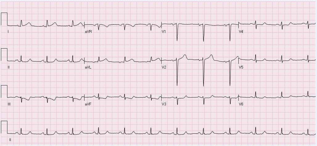 cureus-mixed-connective-tissue-disorder-complicated-by-polymyositis