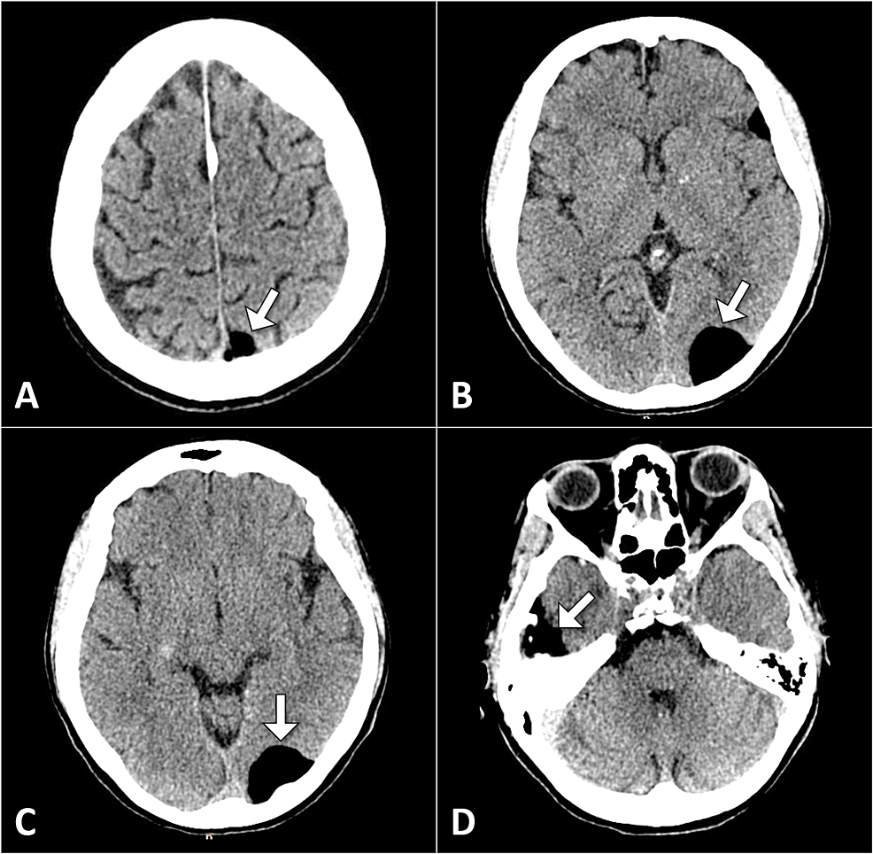 A Case Report Of Ruptured Intracranial Dermoid Cyst Cureus