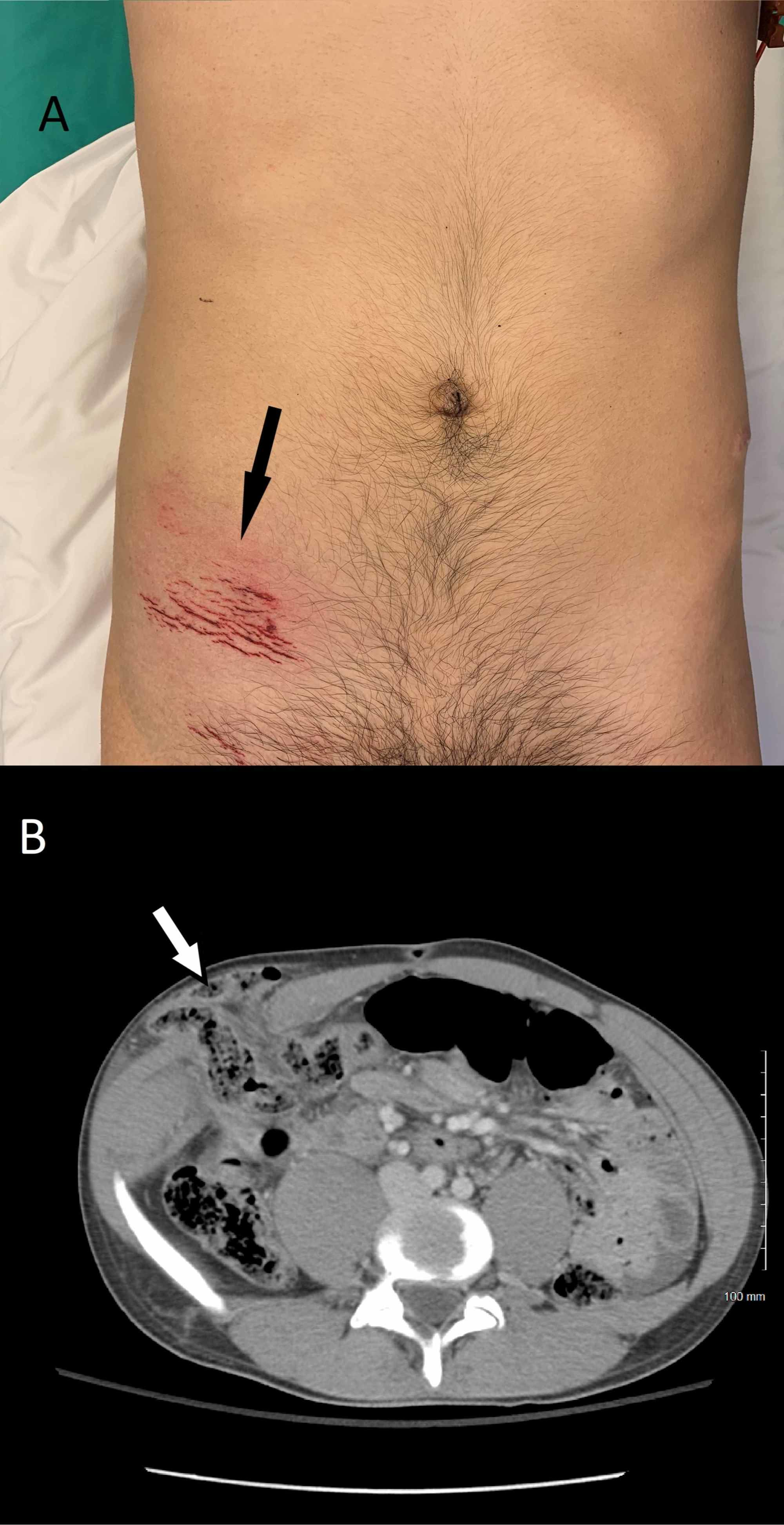 Cureus Management Of Traumatic Spigelian Hernia A Case Report And