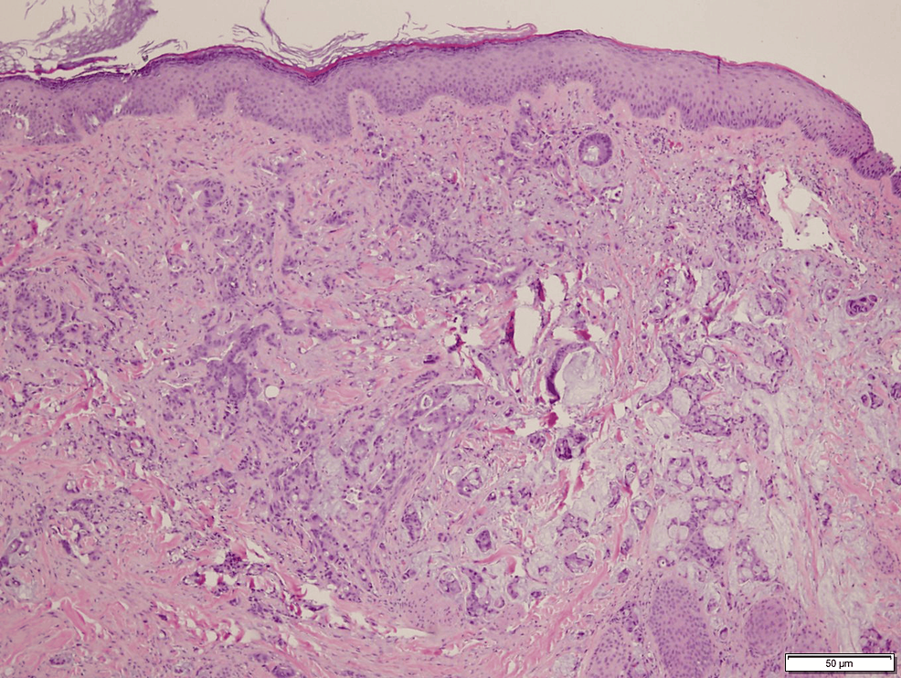 Cureus Cutaneous Metastasis In Colorectal Cancer A Rare And