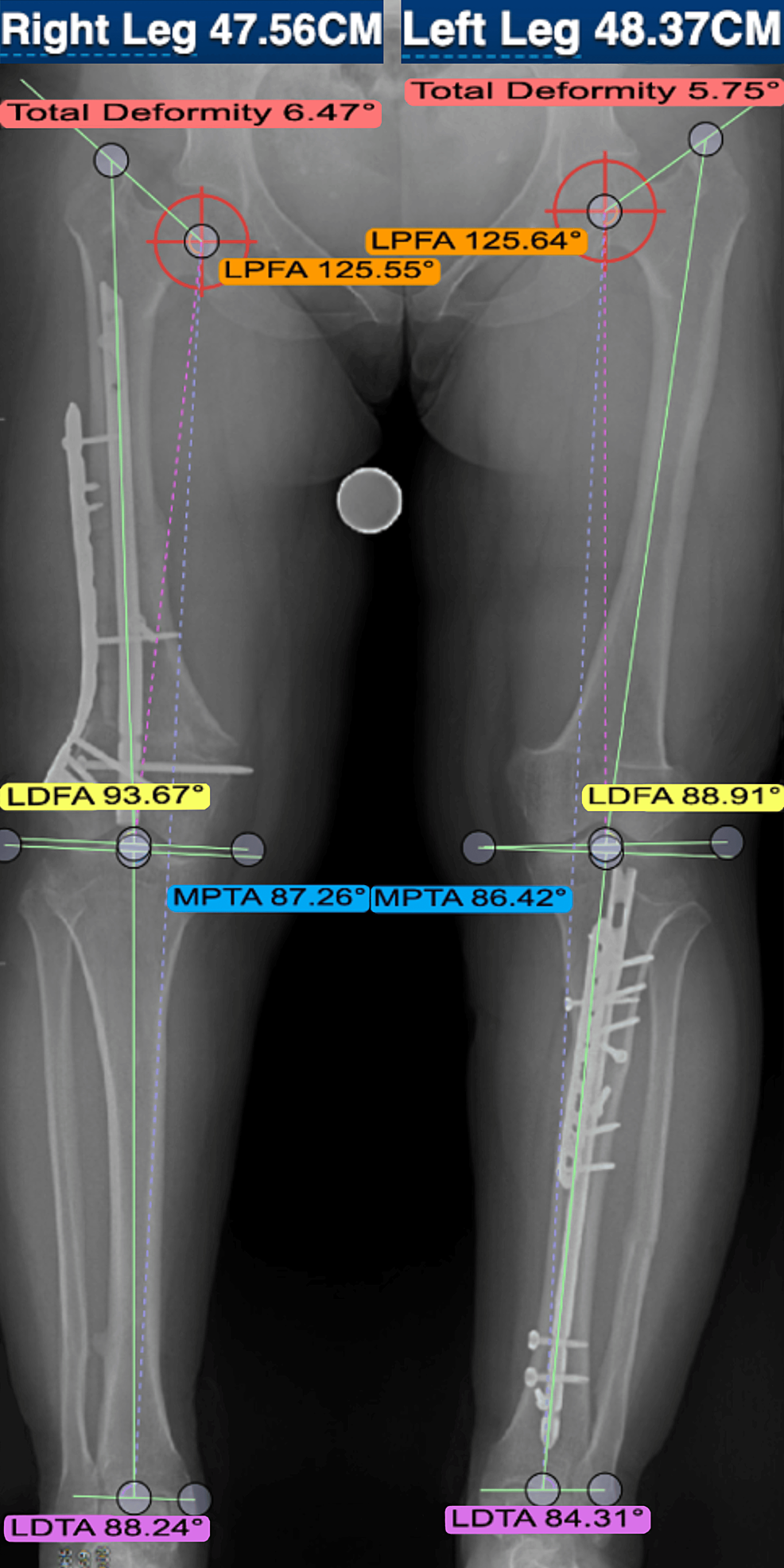 Cureus Analyzing The Accuracy Of Digital Sizing On Long Leg Alignment