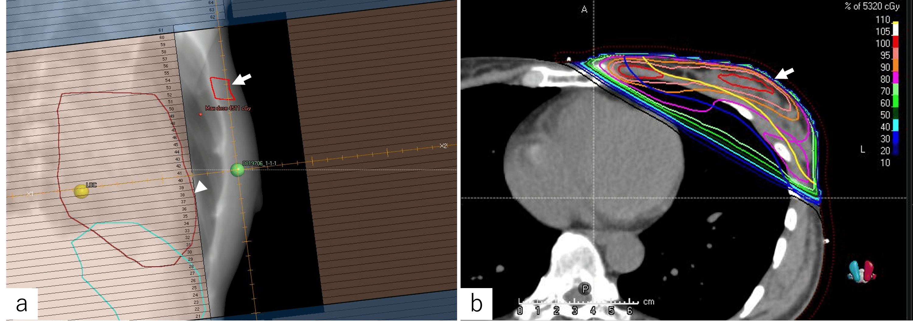 A Case Of Hypofractionated Radiation Therapy For Early Stage Breast