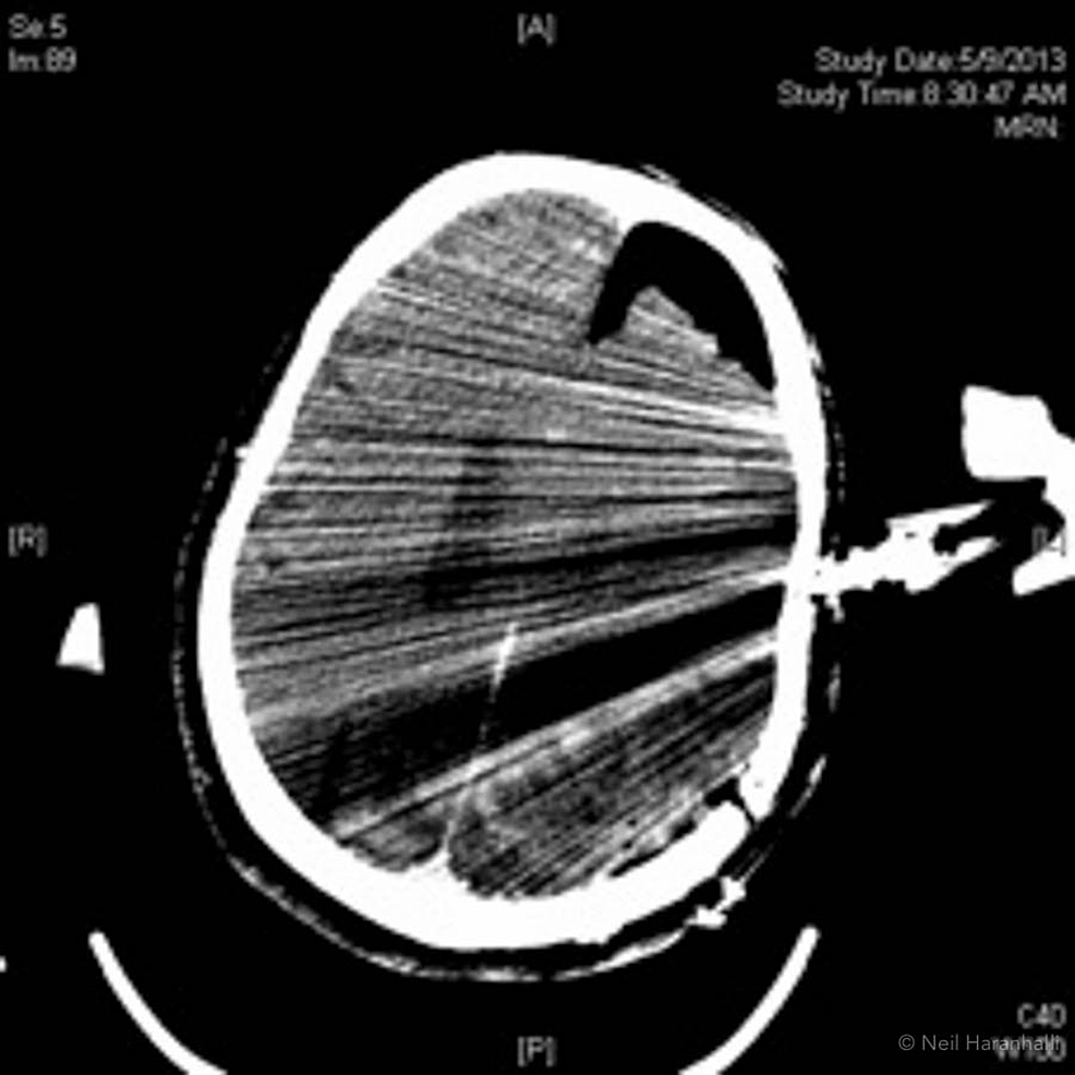 Cureus Radiolucent Skull Clamps for IntraOperative Imaging A