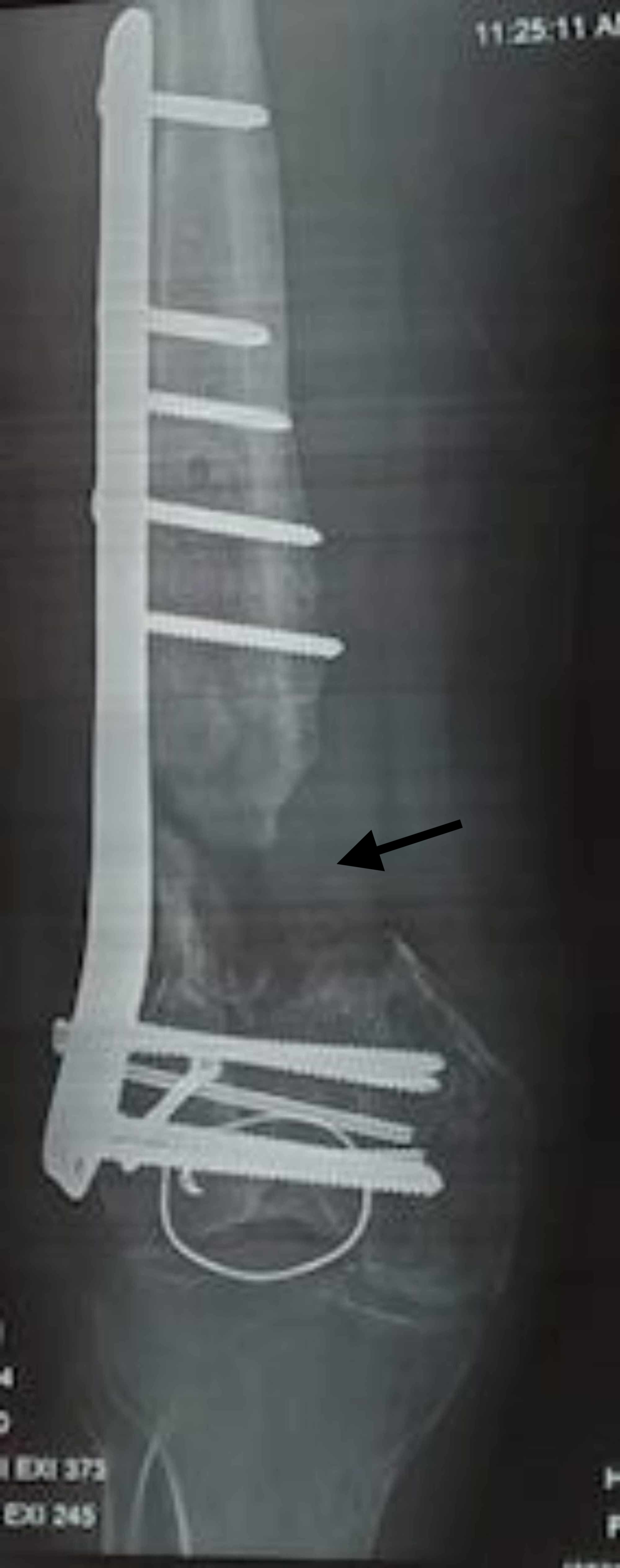 Cureus Dual Plating Of The Distal Femur Indications And Surgical Techniques