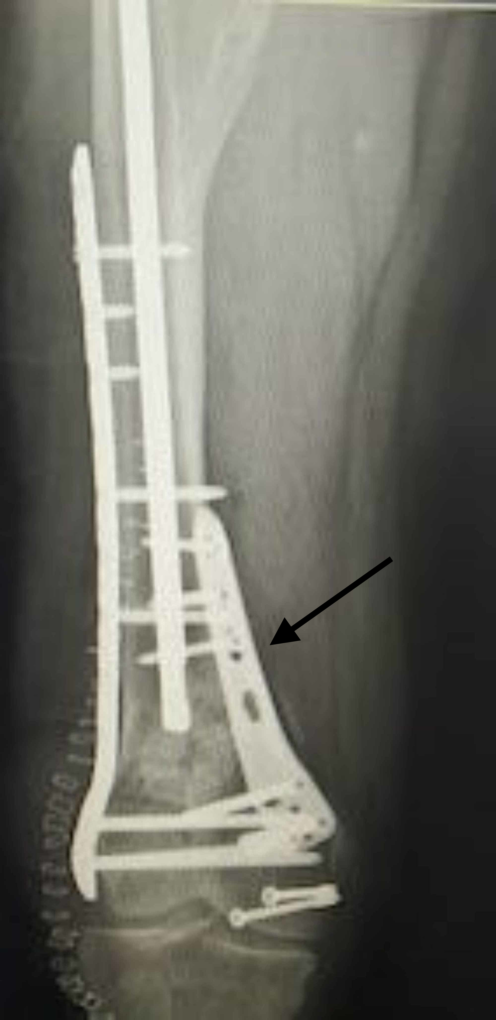 Cureus Dual Plating Of The Distal Femur Indications And Surgical Techniques