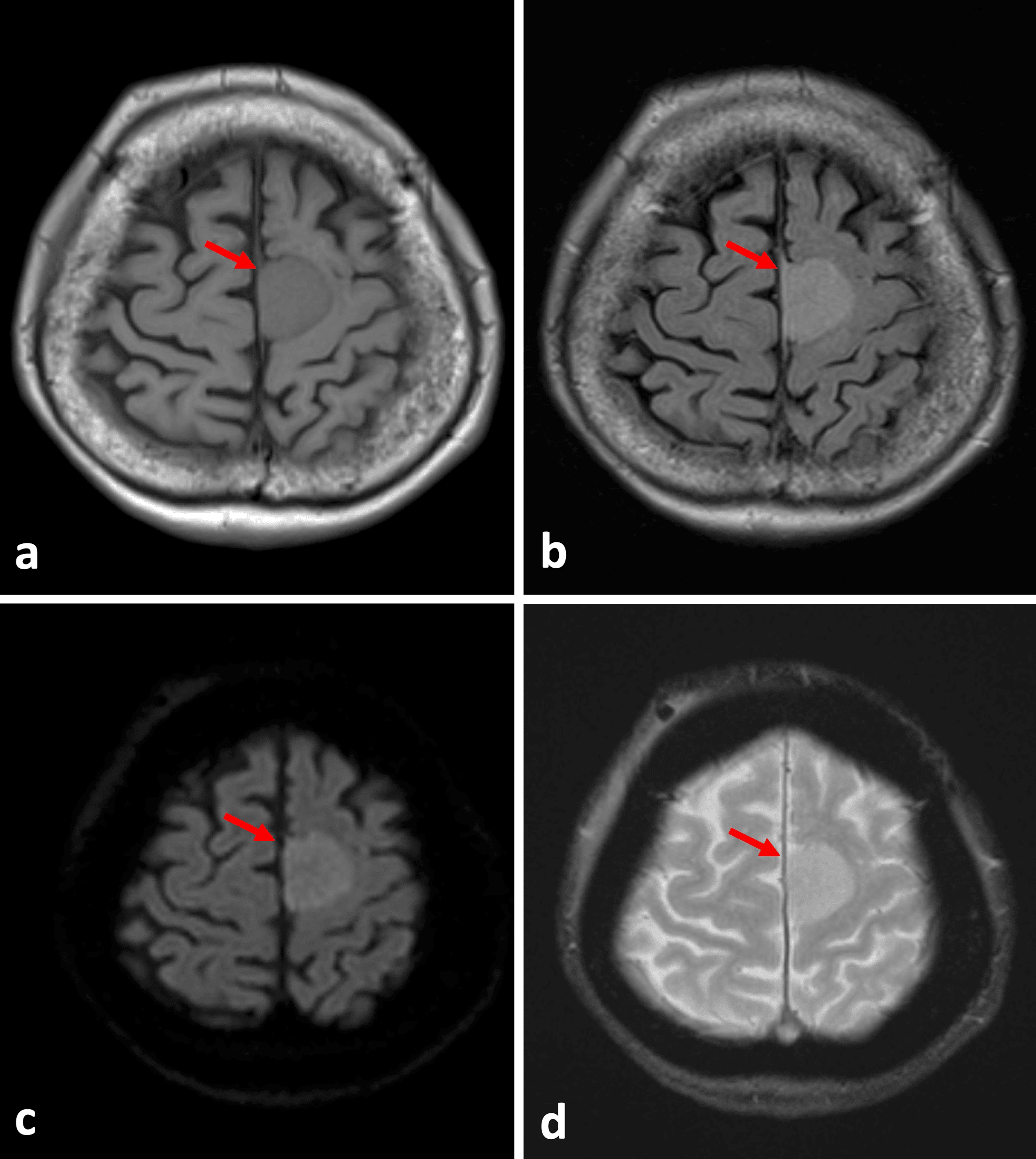 Cureus Interhemispheric Acute Subdural Hematoma Secondary To Falx