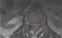 Cureus A Rare Case Presentation Of Apixaban Induced Nontraumatic Spinal Subdural Hematoma