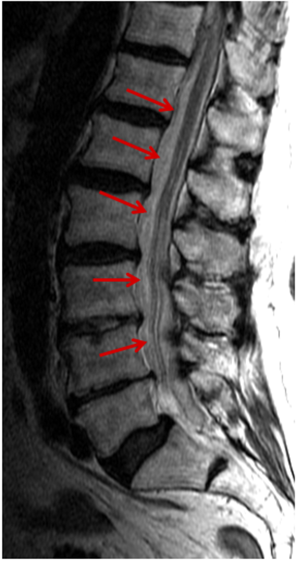 Cureus A Rare Case Presentation Of Apixaban Induced Nontraumatic Spinal Subdural Hematoma