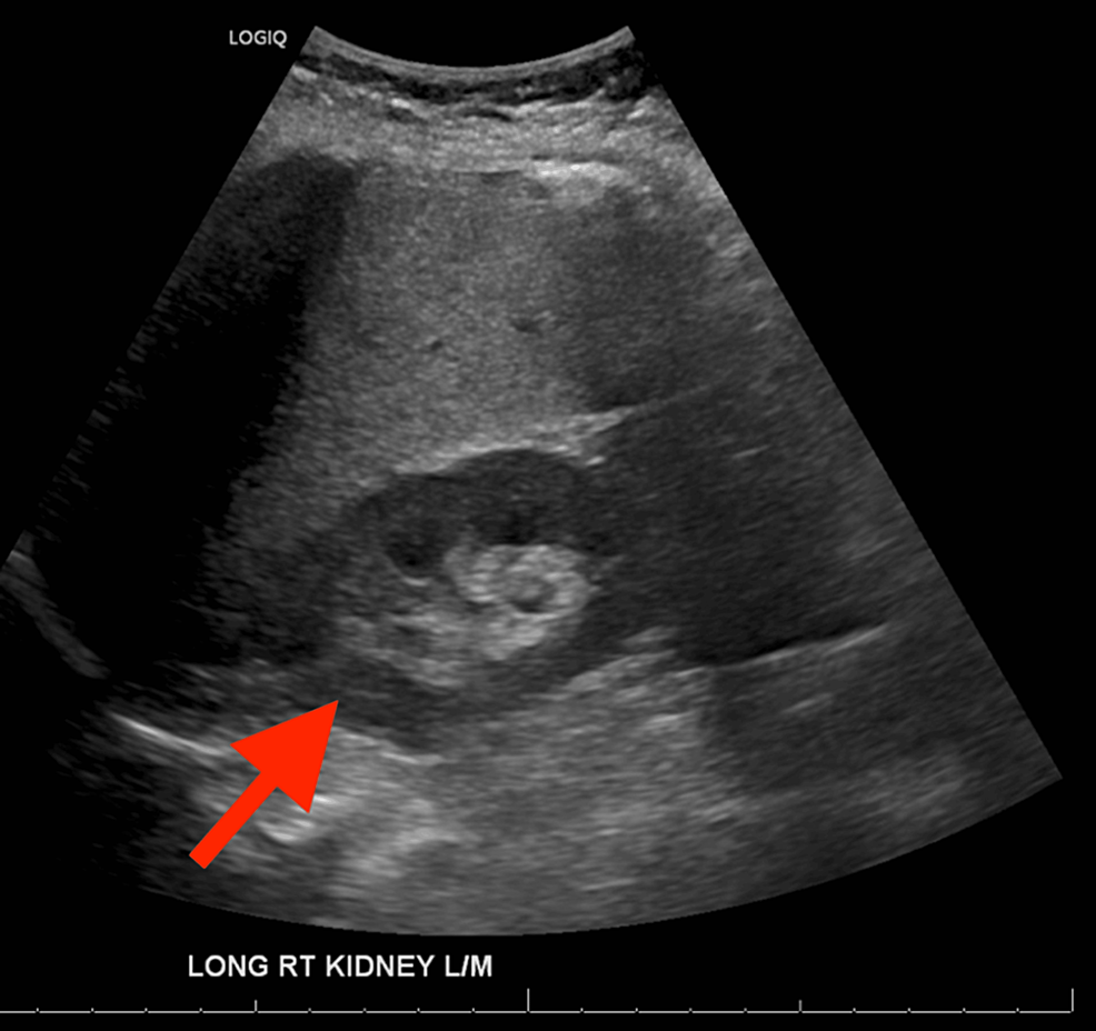 Imaging In Intussusception Sinaiem