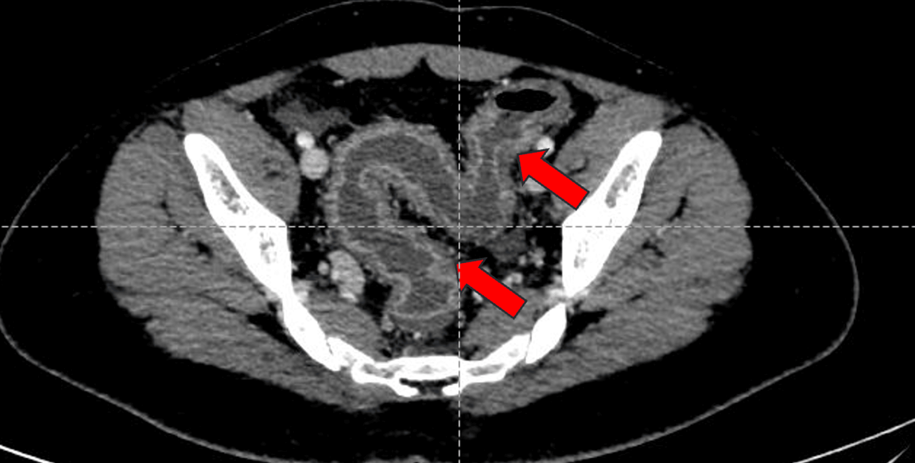 An Unusual Case Of An Immunocompetent Adult Diagnosed With