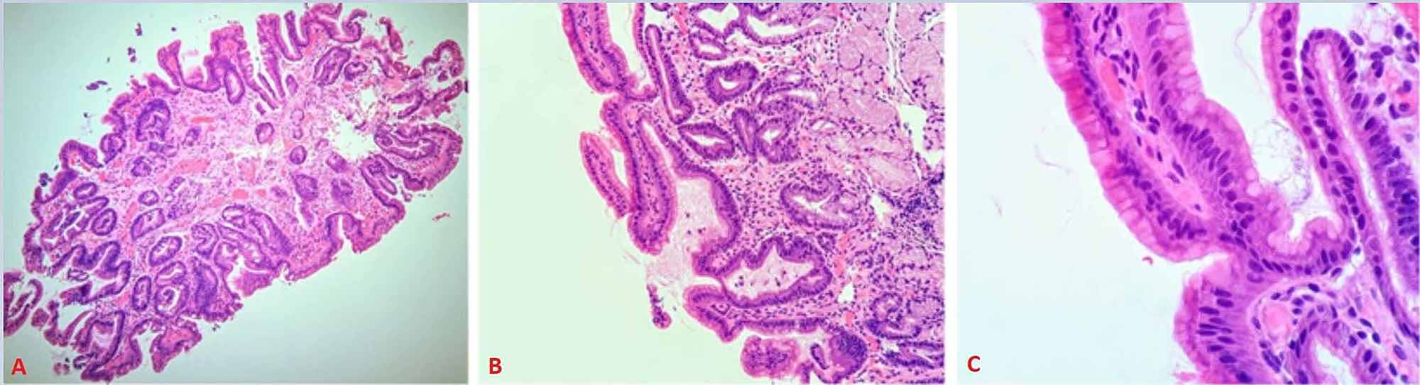 Cureus Brunner's Gland Hyperplasia A Massive Duodenal Lesion
