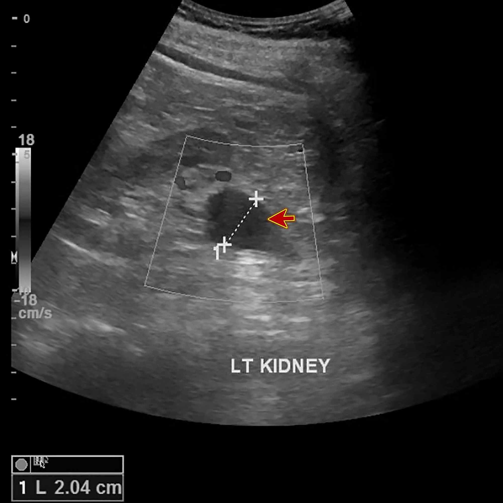 Cureus Follicular Lymphoma Recurrence Presenting as Unilateral Leg