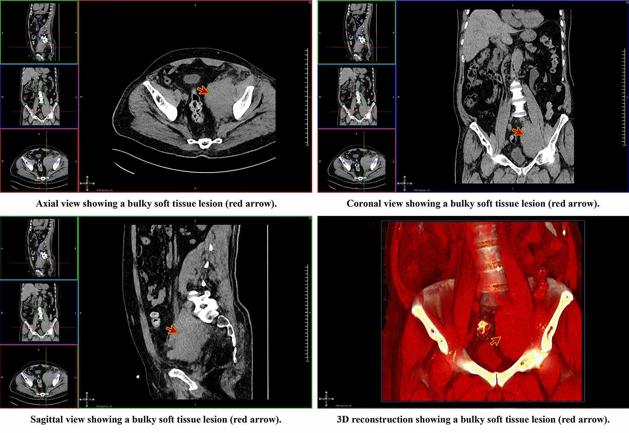 Cureus Follicular Lymphoma Recurrence Presenting as Unilateral Leg