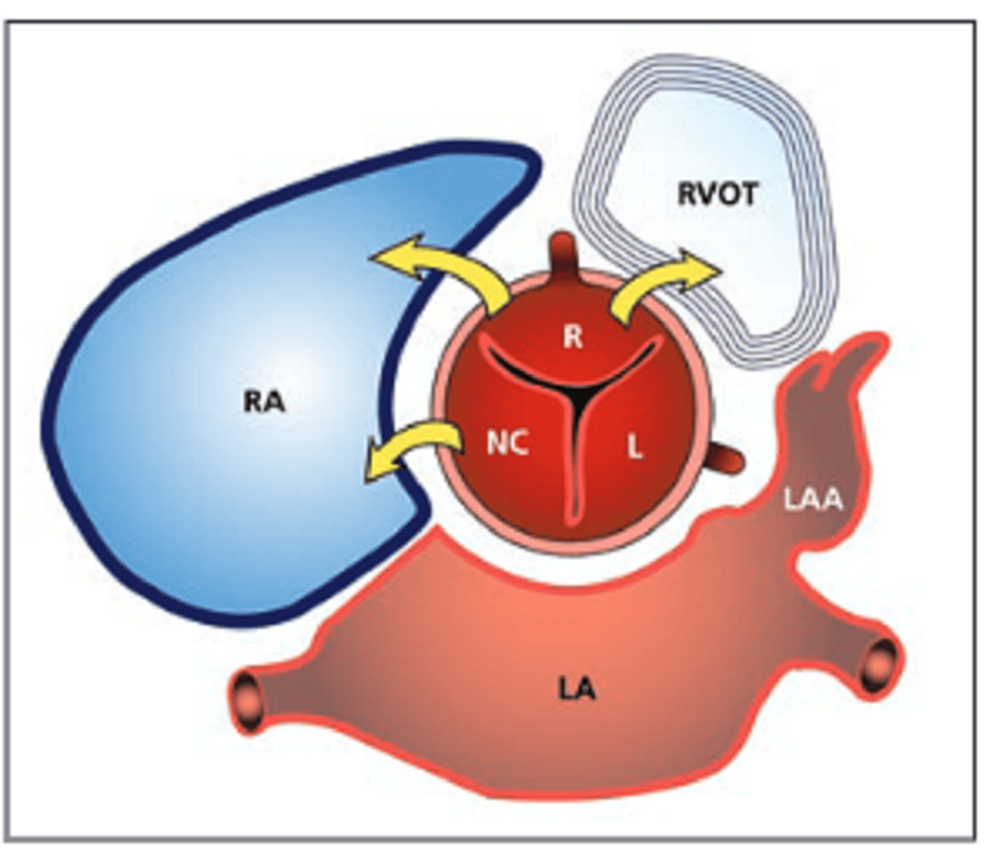 Ruptured Sinus Of Valsalva Aneurysm Three Case Reports And Literature Review Cureus 8046