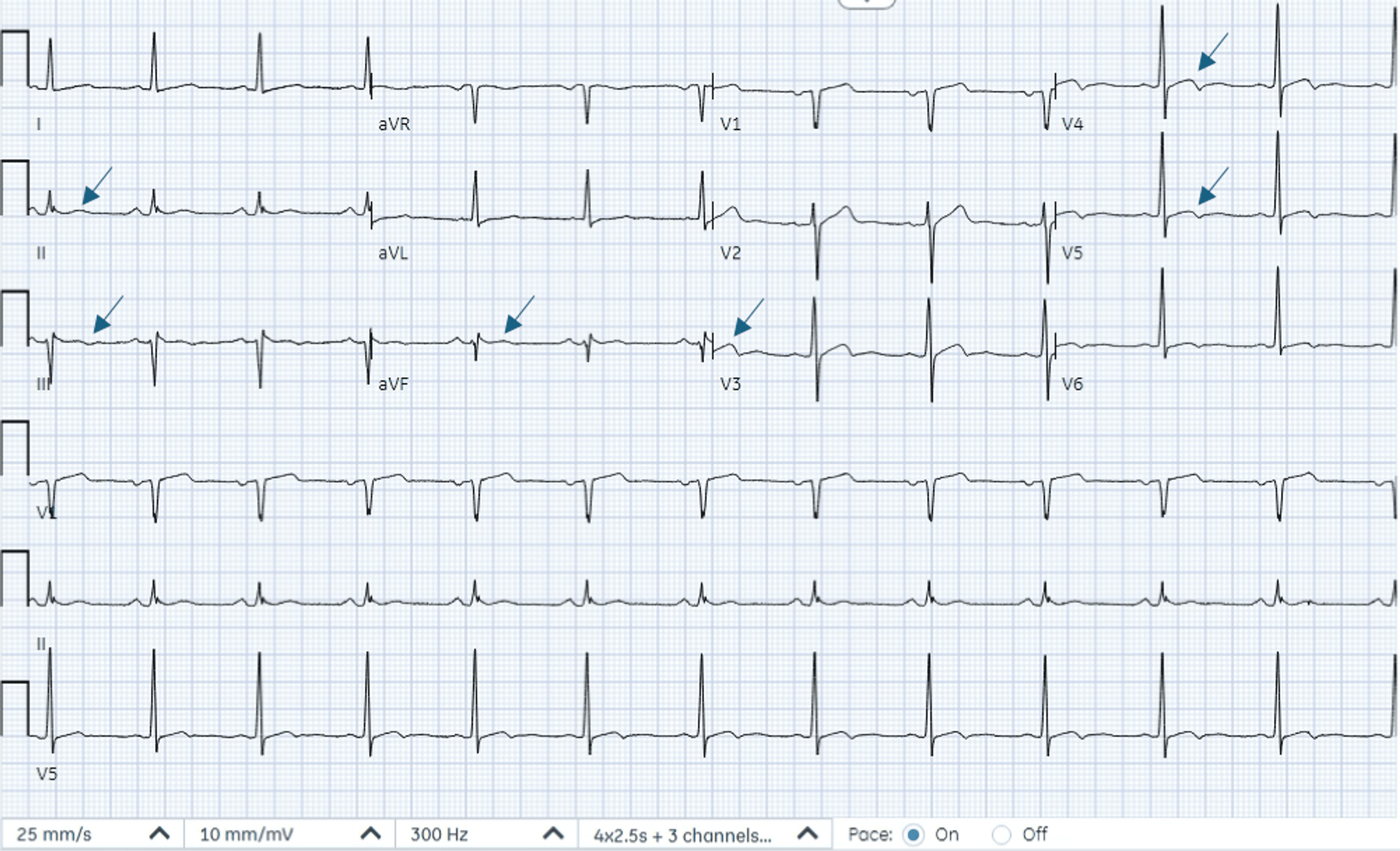 Navigating Diagnostic Challenges in Acute Coronary Syndrome: A Case of ...